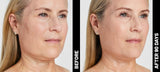 Ultherapy ($350+)