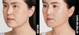 Ultherapy ($350+)